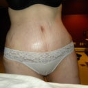 6 weeks post op front (dont mind shinyness, it's vaseline!)