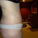 6 weeks post op - side view