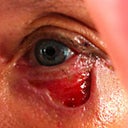juvaderm/vitrase injection site left eye