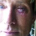 juvaderm/vitrase injection site left eye