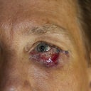 juvaderm/vitrase injection site left eye