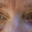 juvaderm/vitrase injection site left eye