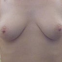 3 months before op