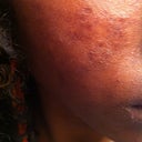 Day 2, right cheek. Already, I was beginning to get that melted saran wrap skin look. Blech!