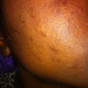 This was about day 5/6. Right cheek. Oh and ignore the little red spot it's not blood, it's pomegranate juice. Haha!