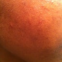 Day 7/8! Right cheek. My skin looks wonderful!
