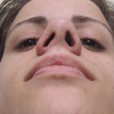 2-25-12: 2.5 months post-op