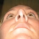 after my 1st rhinoplasty