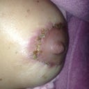 The weird red skin at top of incision