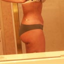 Side Day 2 (swelling has begun)