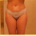 Front Day 14 (still swollen - compare to Day 2)