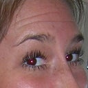 BEFORE BOTOX