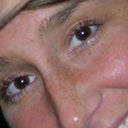 BEFORE BOTOX