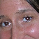 BEFORE BOTOX