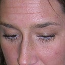 BEFORE BOTOX