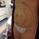Dr's markings.