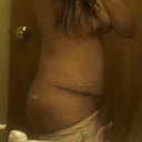 More swollen on this side , 2 wks PO (it switches from day to day)
