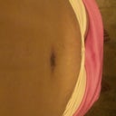 The Bulge above my scar...Seroma?? or Swelling???, 2 wks PO