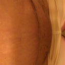 Very swollen "Cuca", 2 wks PO