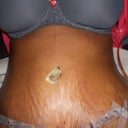p.o day 4 still have stretchmarks, but i got a flat stomach