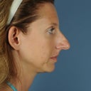 Here is a "before" photo taken at my doctor's office.  You can see my nose was very large.  I just want to have a nose that doesn't get as much negative attention.
