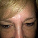 today I got juvederm, this is the picture 3 hrs after, it filled in the cracks and its on its way to being normal!!!! yay