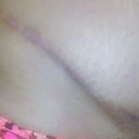 High scar - right side