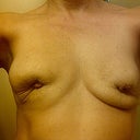 8 weeks post explant...guess it's going to  be like this for a year.