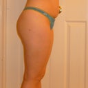 6 weeks PO~ I can't see much of a difference from the side