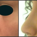 Left: Profile before surgery, Right: Profile after surgery