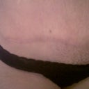 TT scar 6 months