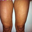 Before cellulaze