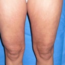 3 months after cellulaze