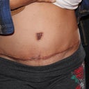 Scar using Maderma