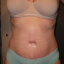 PO day 13, swelling isn't really going anywhere. Although it isn't really that bad