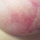 venous congestion causing red/blue bruised appearance