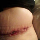 incision still horrible but making slow progress. If you have any tips on how to speed up healing please let me know :)