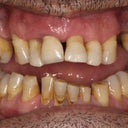 My teeth before dental implants