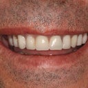 My teeth after dental implants