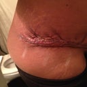 Left side 3 day PO. Is this thing suppose to b this dang thick?