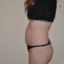 Side view abdomen, before