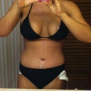 10 days PO, very swollen belly button but so far I'm happy with my results. Can't wait for that last drain out.