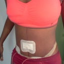 after side view no more stretch marks or hanging skin im happy! pod 2
