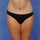 at 8 weeks, have some swelling and  still am not standing complete straight but close enough.