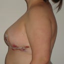 Two days post op.