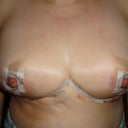 Two days post op, close up.