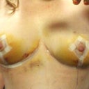 Day 5 Post Op.  Loving the new girls!  No more pain!  They are roughly a size C/D