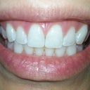 Almost a year later.  Still wearing my Invisalign retainers at night.