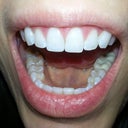 I also had my dentist even out the length of my 2 front teeth.  I'm very pleased!