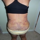 Post op day 4..my back, I am still hunched over!